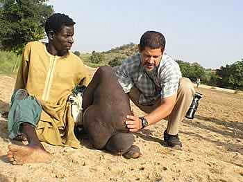 filariasis